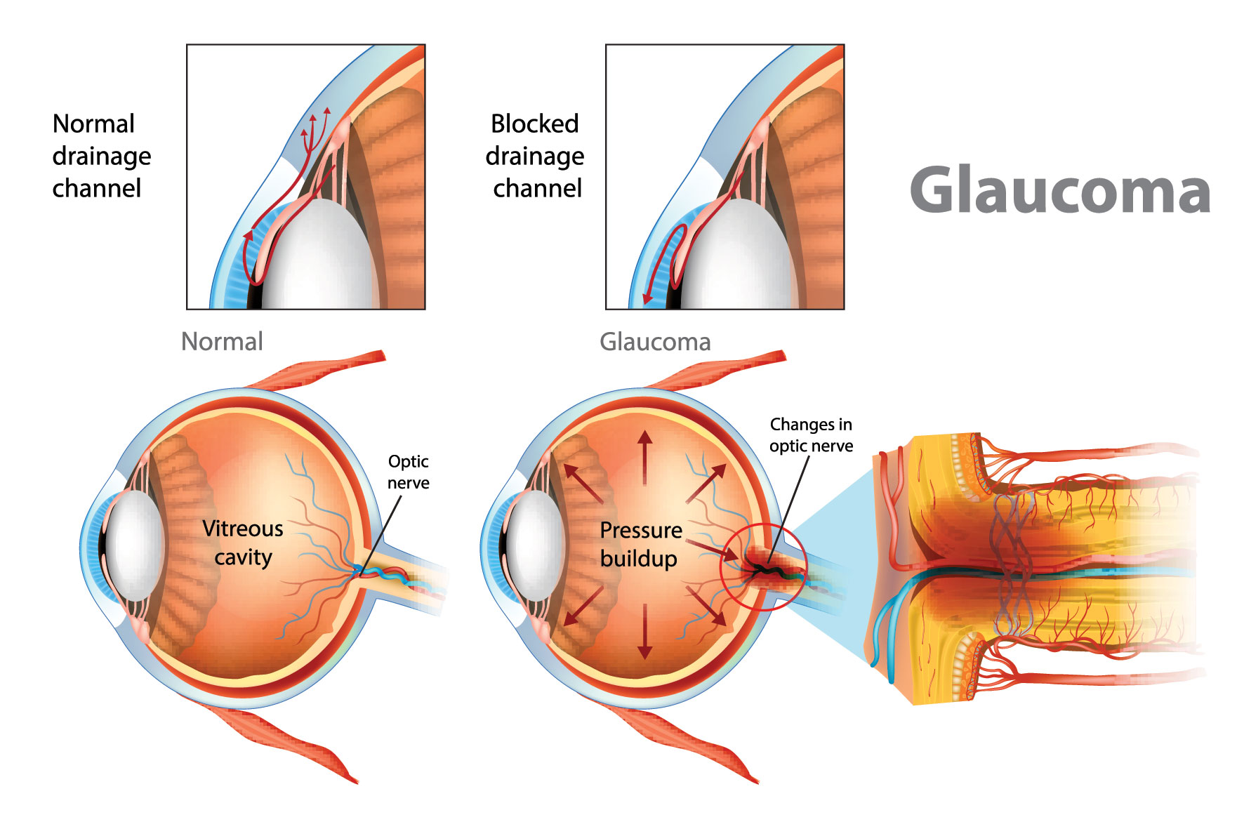 glaucoma illustration