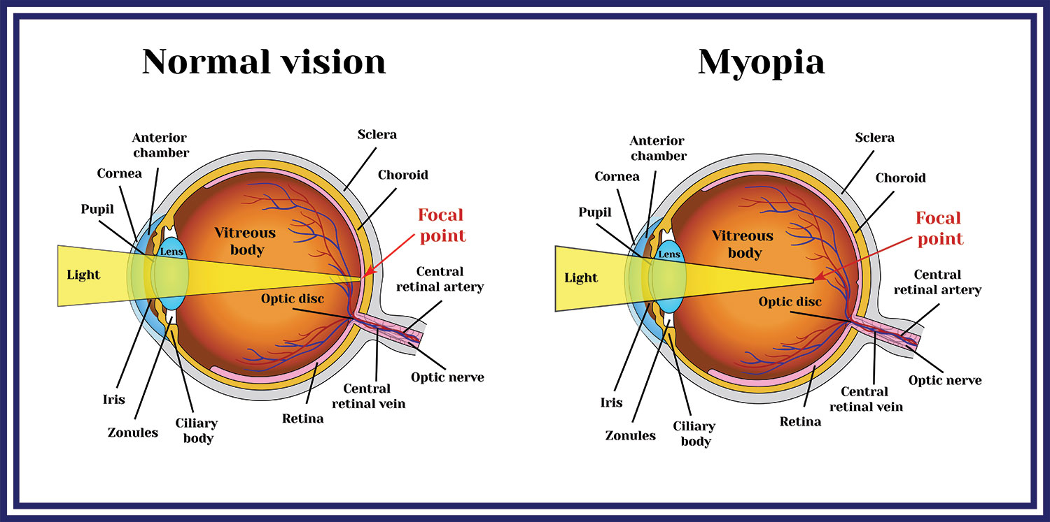 Myopia Illustration