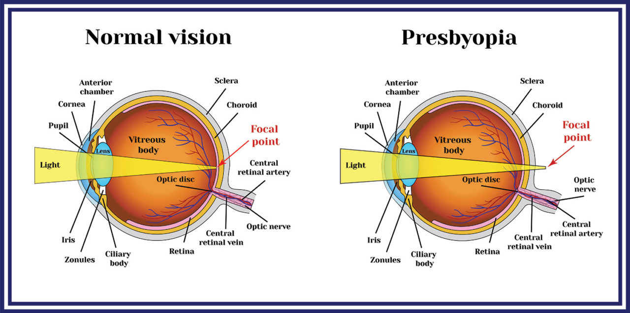 presbyopia-azar-eye-clinic