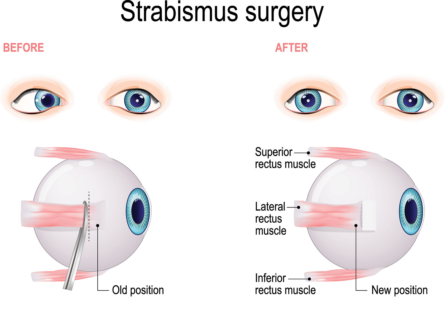 strabismus surgery illustration
